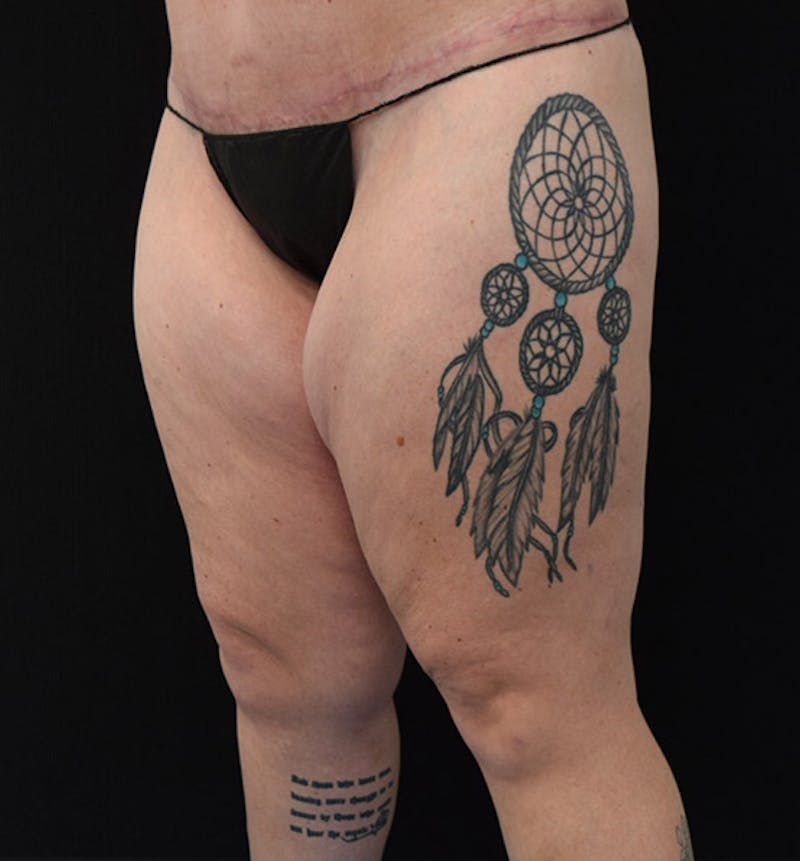 Thigh Lift Before & After Gallery - Patient 102566529 - Image 7