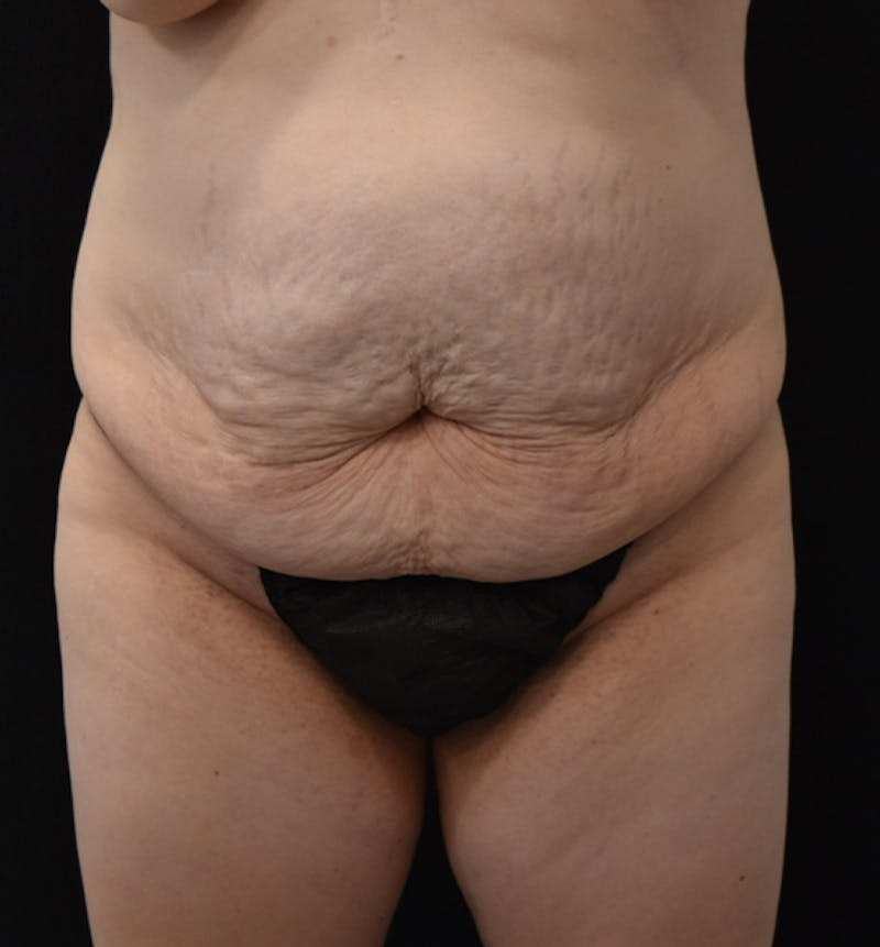 Lower Body Lift Before & After Gallery - Patient 102566537 - Image 1