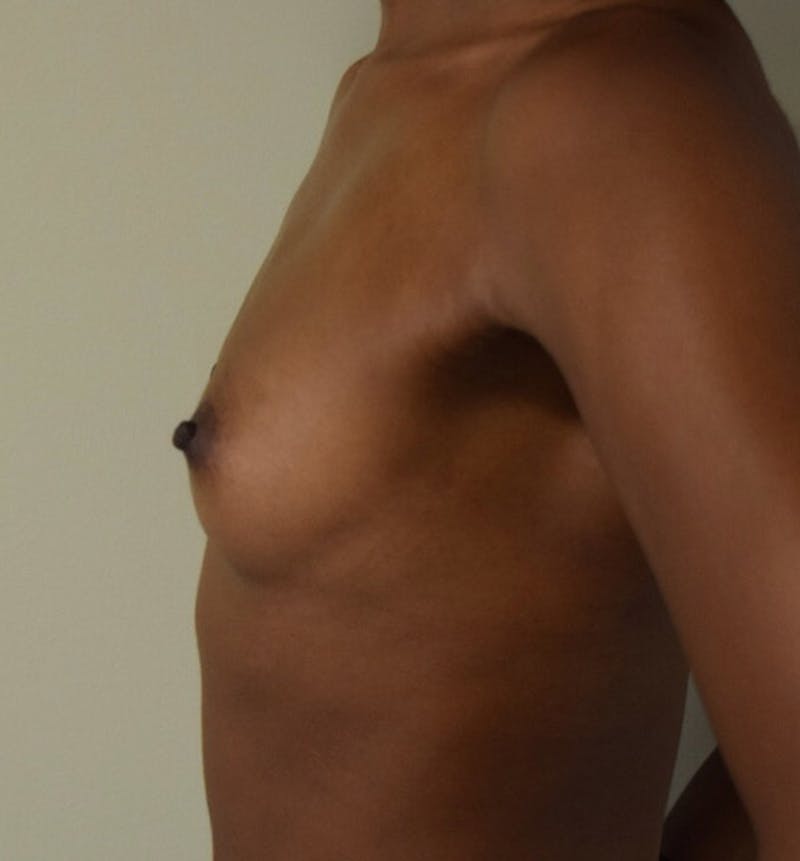 Breast Augmentation Before & After Gallery - Patient 102566524 - Image 5