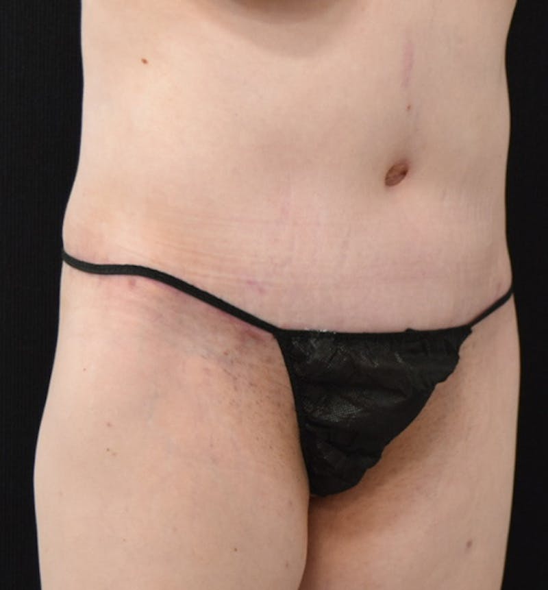 Lower Body Lift Before & After Gallery - Patient 102566537 - Image 4