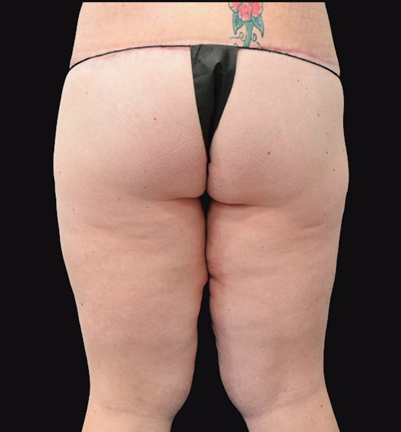 Thigh Lift Before & After Gallery - Patient 102566529 - Image 11