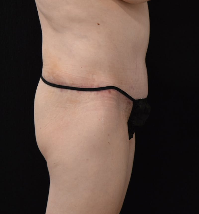 Lower Body Lift Before & After Gallery - Patient 102566537 - Image 6
