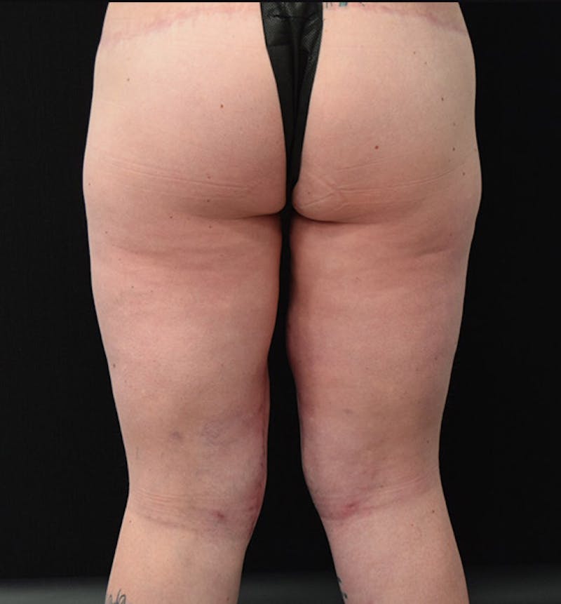 Thigh Lift Before & After Gallery - Patient 102566529 - Image 12