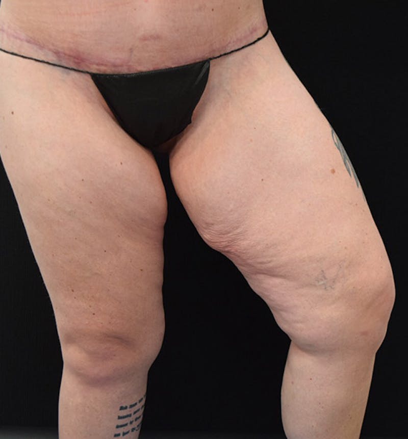 Thigh Lift Before & After Gallery - Patient 102566529 - Image 13