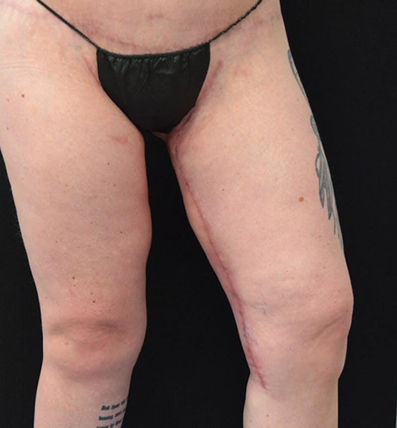 Thigh Lift Before & After Gallery - Patient 102566529 - Image 14