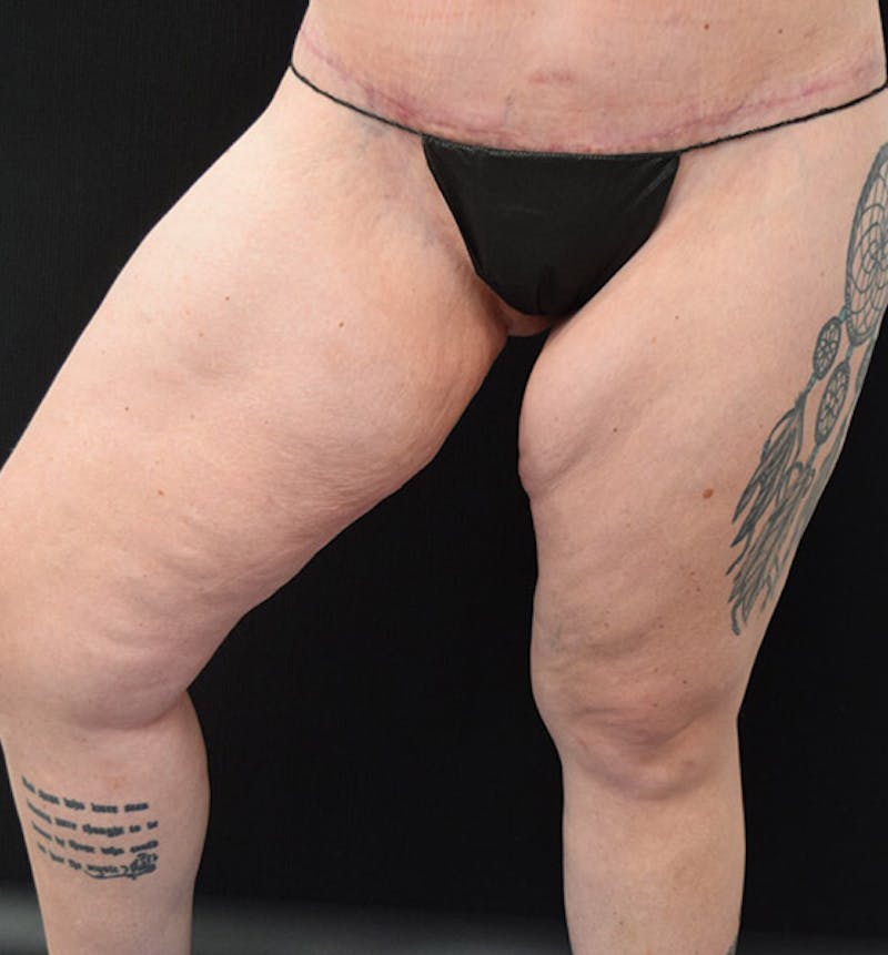 Thigh Lift Before & After Gallery - Patient 102566529 - Image 15