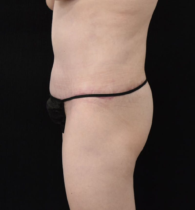 Lower Body Lift Before & After Gallery - Patient 102566537 - Image 10