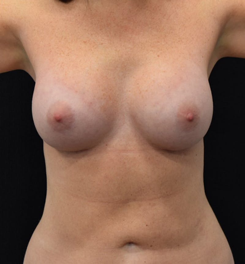 Breast Augmentation Before & After Gallery - Patient 102566878 - Image 2