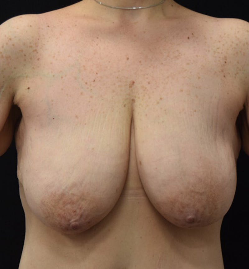 Breast Augmentation Gallery - Patient 102566887 - Image 1