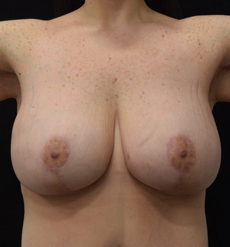 Breast Augmentation Gallery - Patient 102566887 - Image 2