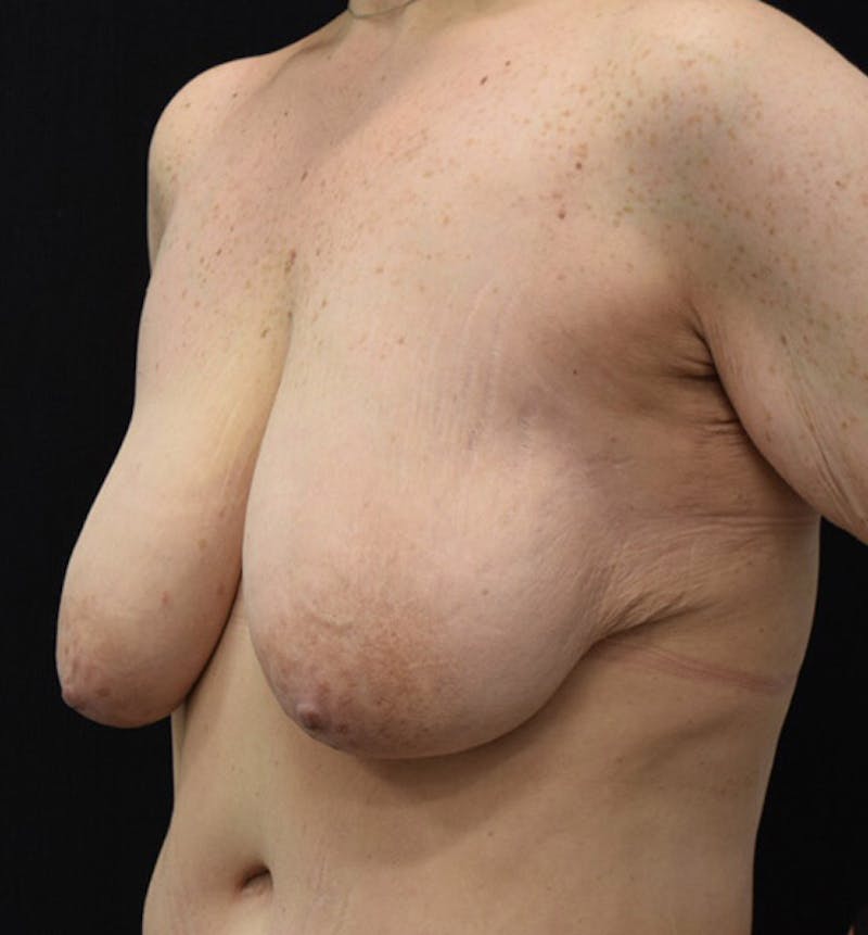 Breast Augmentation Before & After Gallery - Patient 102566887 - Image 3