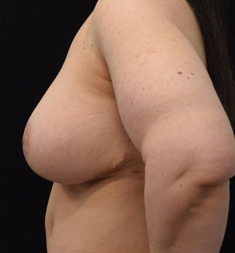 Breast Augmentation Before & After Gallery - Patient 102566887 - Image 6