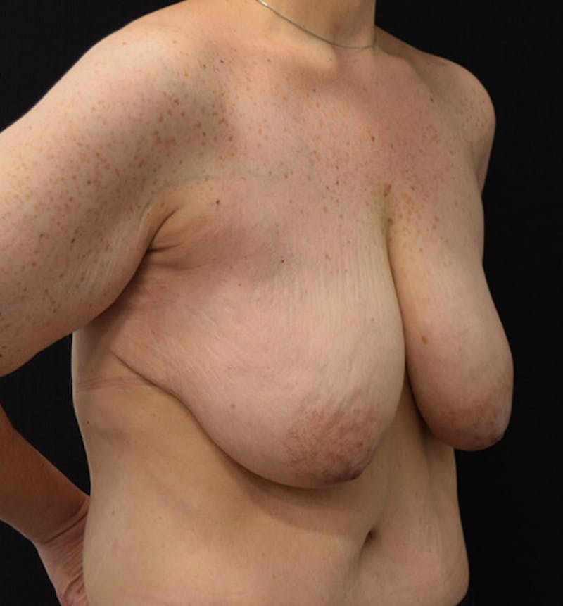 Breast Augmentation Before & After Gallery - Patient 102566887 - Image 7