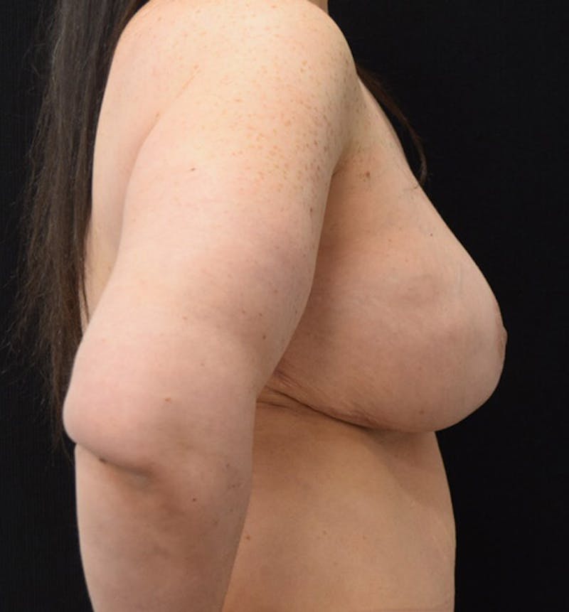 Breast Augmentation Before & After Gallery - Patient 102566887 - Image 10