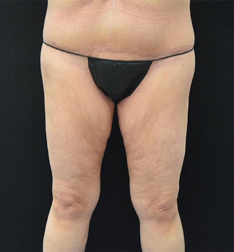 Thigh Lift Gallery - Patient 102566990 - Image 1