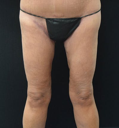 Thigh Lift Before & After Gallery - Patient 102566990 - Image 2
