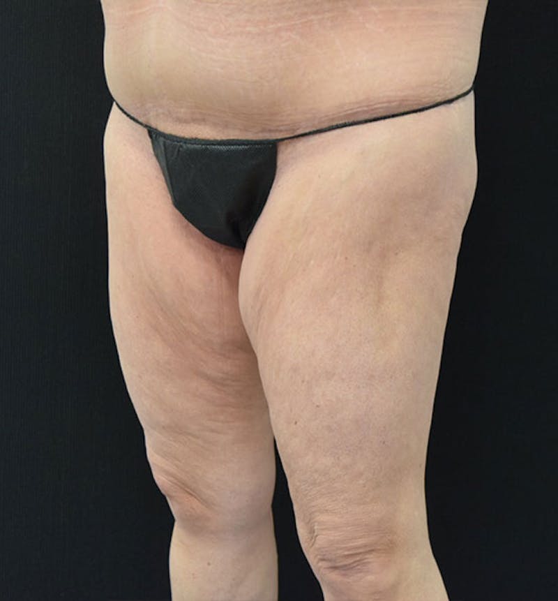 Thigh Lift Before & After Gallery - Patient 102566990 - Image 3