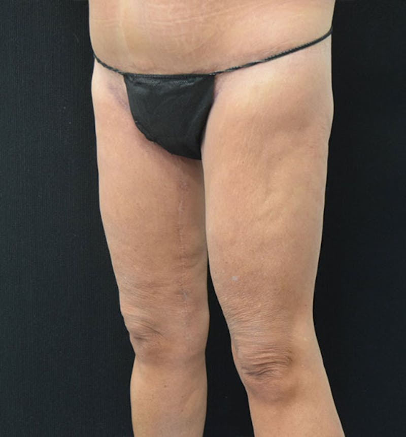 Thigh Lift Before & After Gallery - Patient 102566990 - Image 4