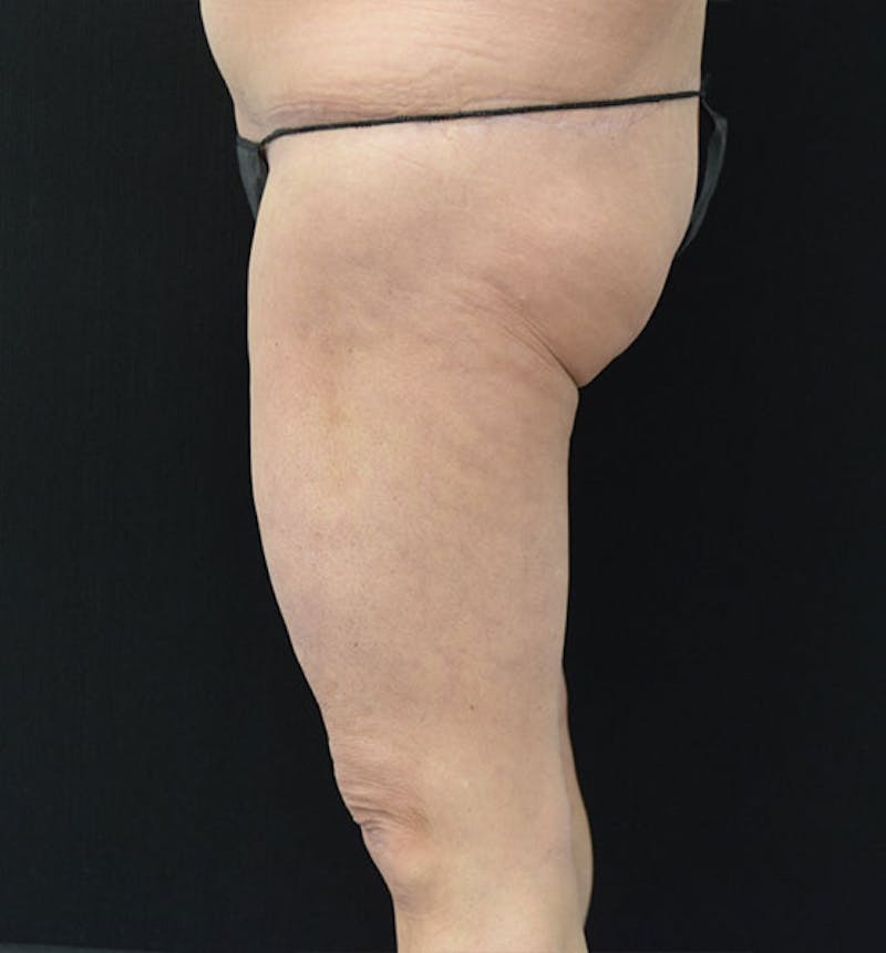 Thigh Lift Before & After Gallery - Patient 102566990 - Image 5