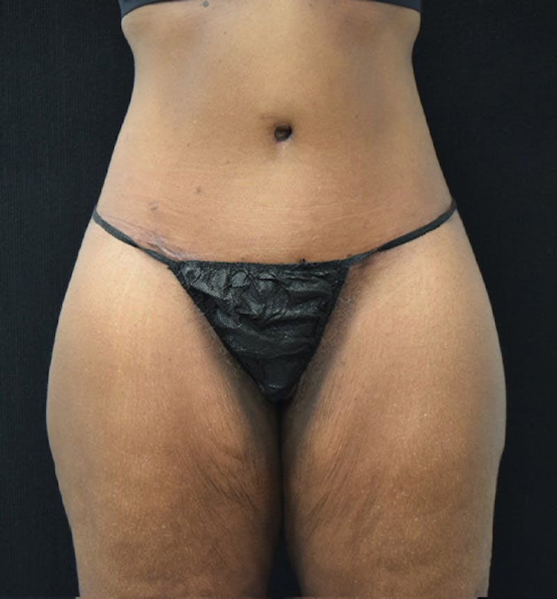 Lower Body Lift Before & After Gallery - Patient 102566994 - Image 2