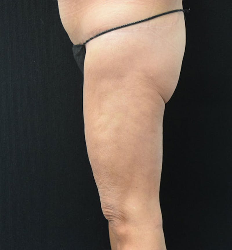 Thigh Lift Before & After Gallery - Patient 102566990 - Image 6