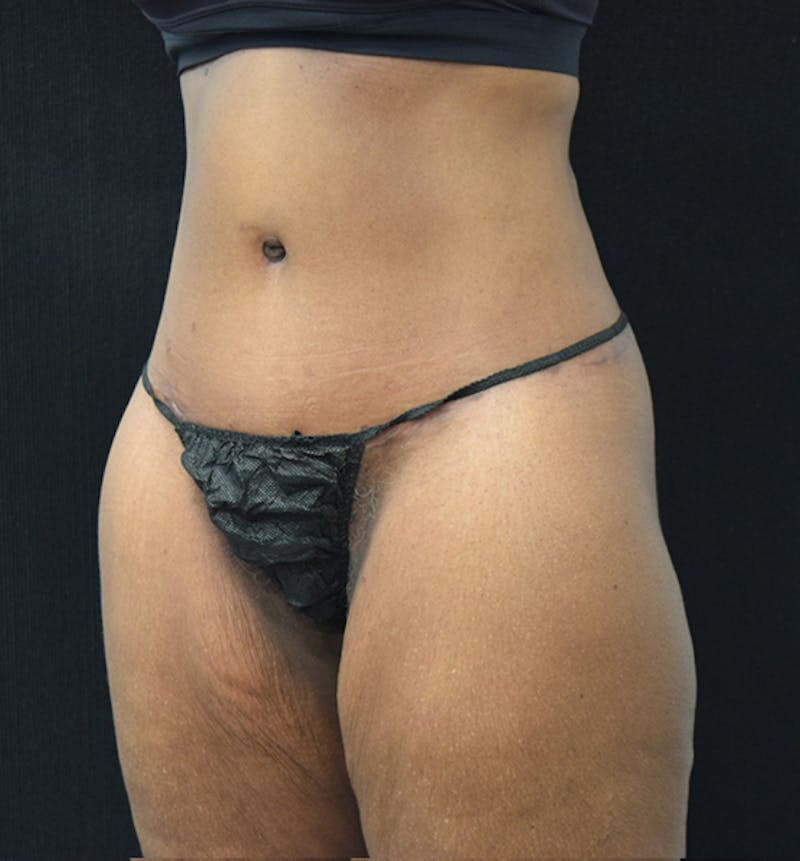 Lower Body Lift Before & After Gallery - Patient 102566994 - Image 4