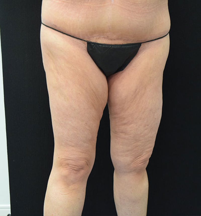Thigh Lift Before & After Gallery - Patient 102566990 - Image 7