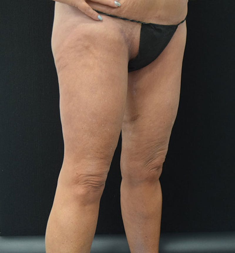 Thigh Lift Gallery - Patient 102566990 - Image 8