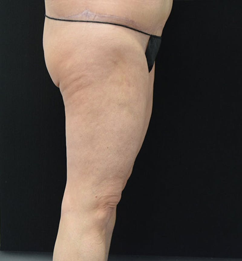 Thigh Lift Gallery - Patient 102566990 - Image 9
