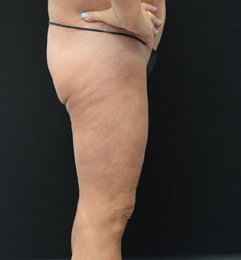 Thigh Lift Before & After Gallery - Patient 102566990 - Image 10