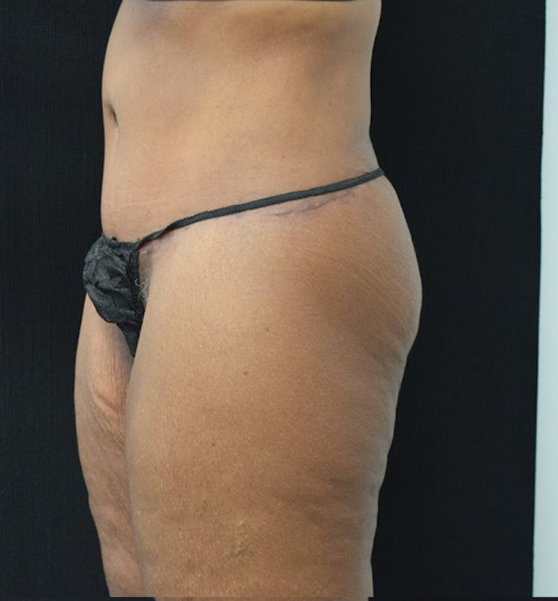 Lower Body Lift Before & After Gallery - Patient 102566994 - Image 6
