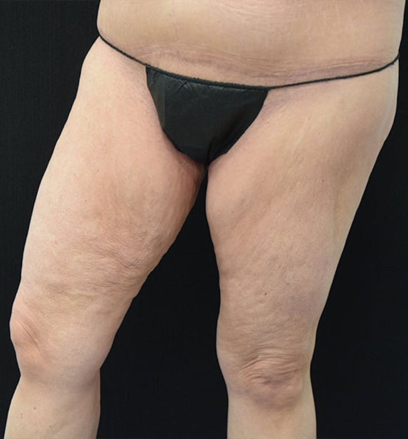 Thigh Lift Gallery - Patient 102566990 - Image 13