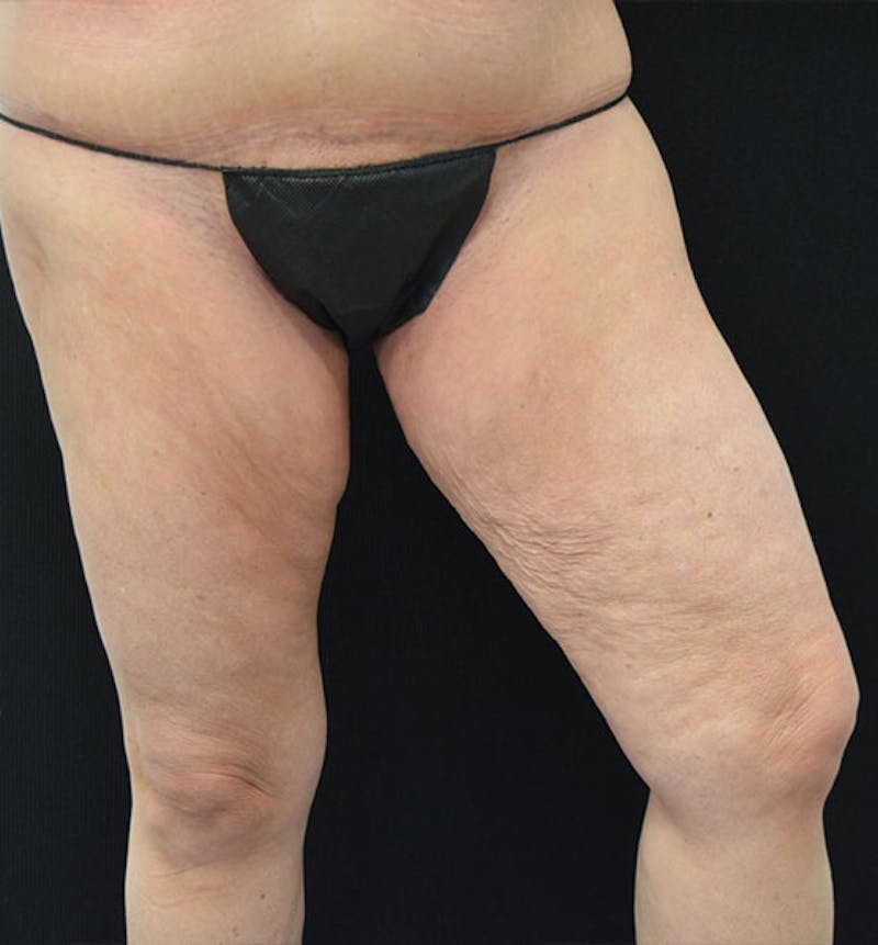 Thigh Lift Before & After Gallery - Patient 102566990 - Image 15