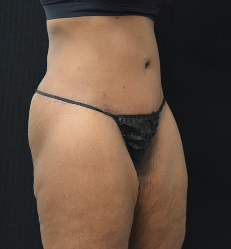 Lower Body Lift Gallery - Patient 102566994 - Image 8
