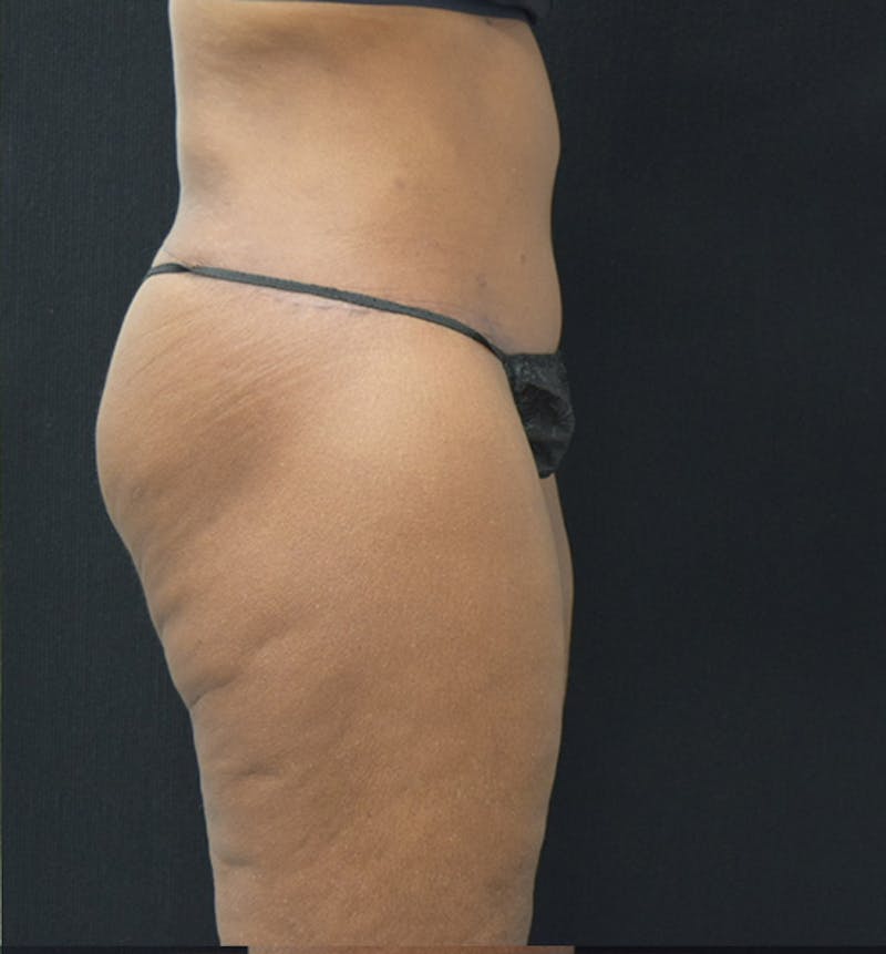 Lower Body Lift Before & After Gallery - Patient 102566994 - Image 10