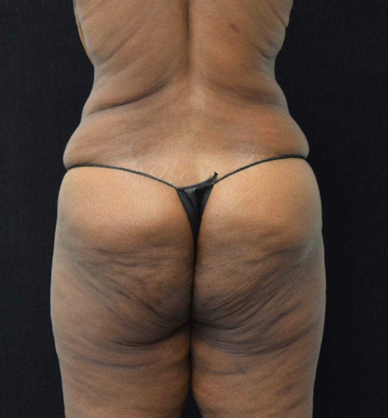 Lower Body Lift Before & After Gallery - Patient 102566994 - Image 11