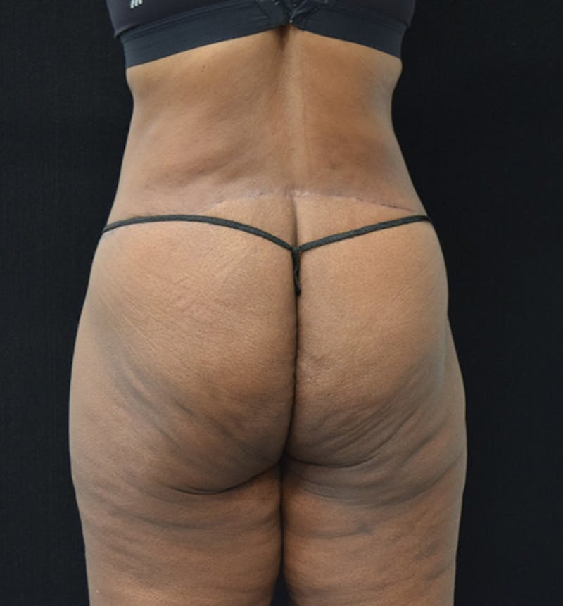 Lower Body Lift Before & After Gallery - Patient 102566994 - Image 12
