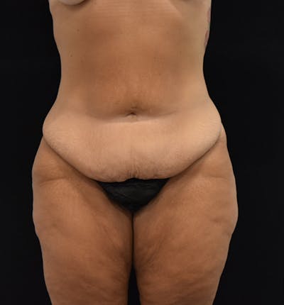 Lower Body Lift Before & After Gallery - Patient 102567025 - Image 1