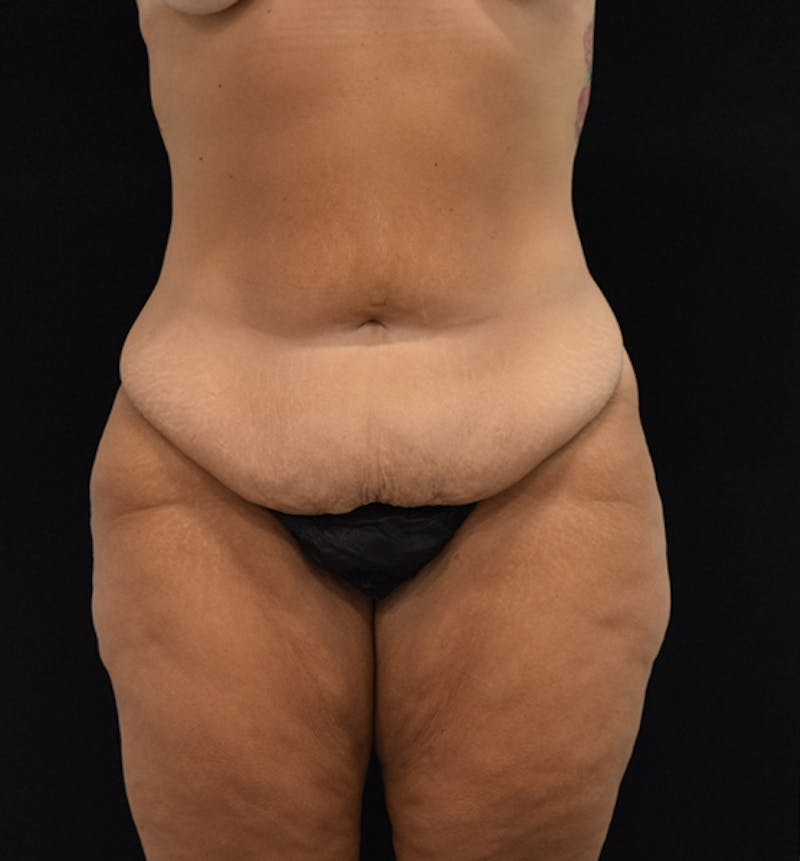 Lower Body Lift Before & After Gallery - Patient 102567025 - Image 1