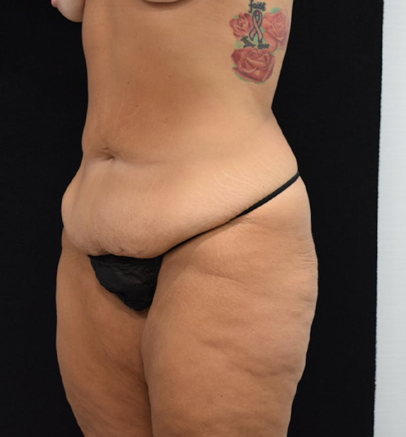 Lower Body Lift Before & After Gallery - Patient 102567025 - Image 3