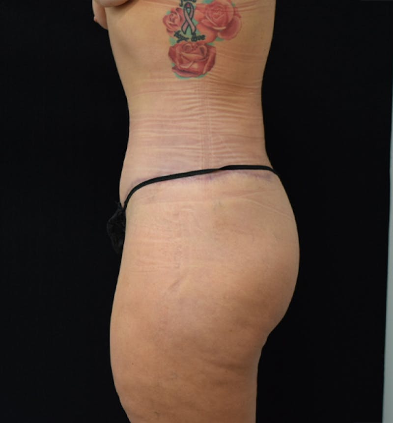 Lower Body Lift Before & After Gallery - Patient 102567025 - Image 6