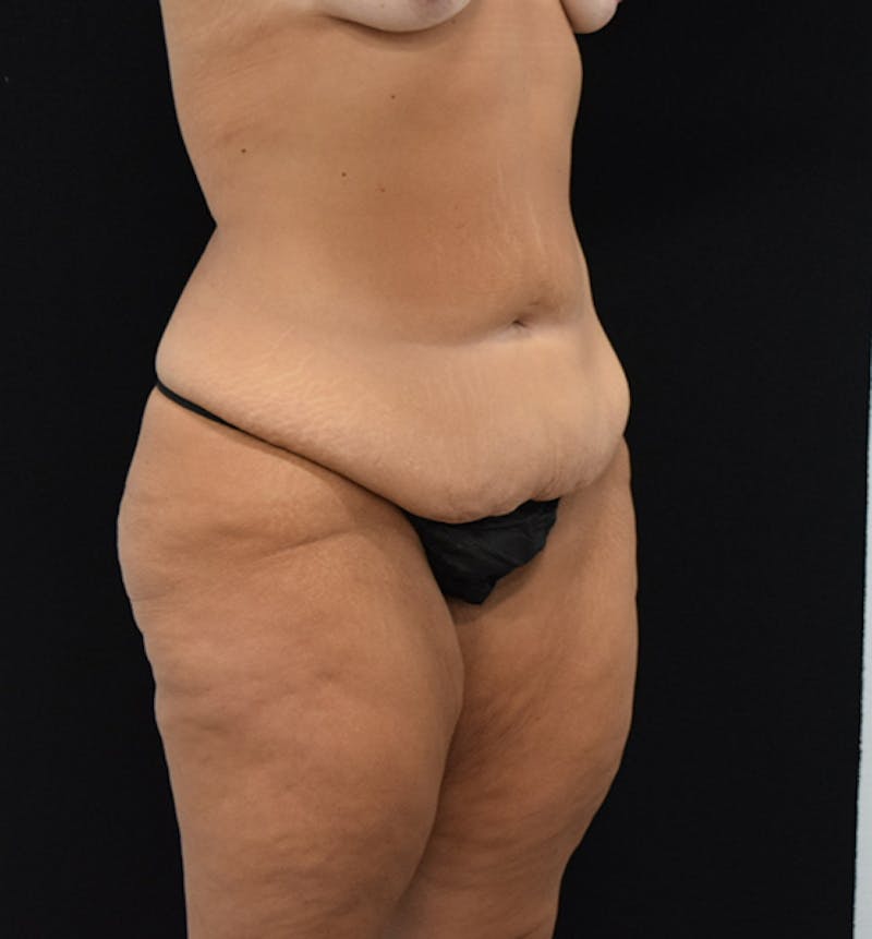 Lower Body Lift Before & After Gallery - Patient 102567025 - Image 7