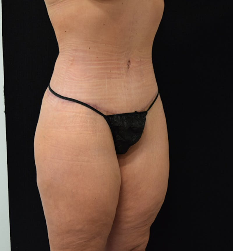 Lower Body Lift Gallery - Patient 102567025 - Image 8