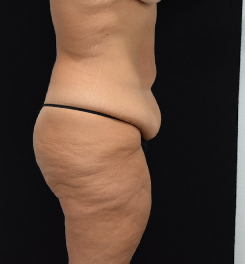 Lower Body Lift Before & After Gallery - Patient 102567025 - Image 9