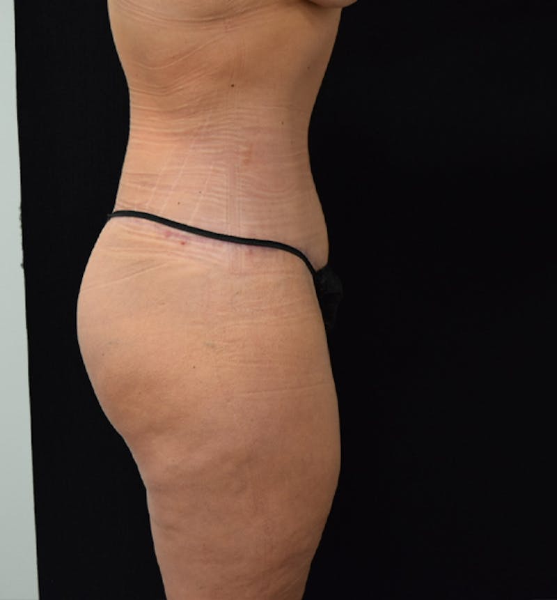 Lower Body Lift Gallery - Patient 102567025 - Image 10