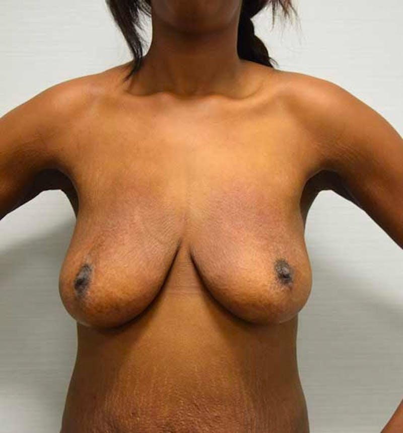 Breast Lift Before & After Gallery - Patient 102567032 - Image 1