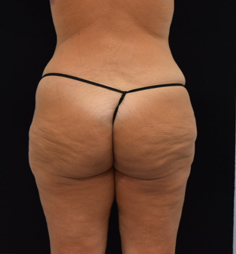 Lower Body Lift Before & After Gallery - Patient 102567025 - Image 11