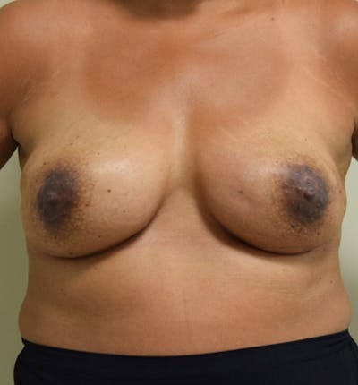 Breast Reconstruction Gallery - Patient 102567034 - Image 2