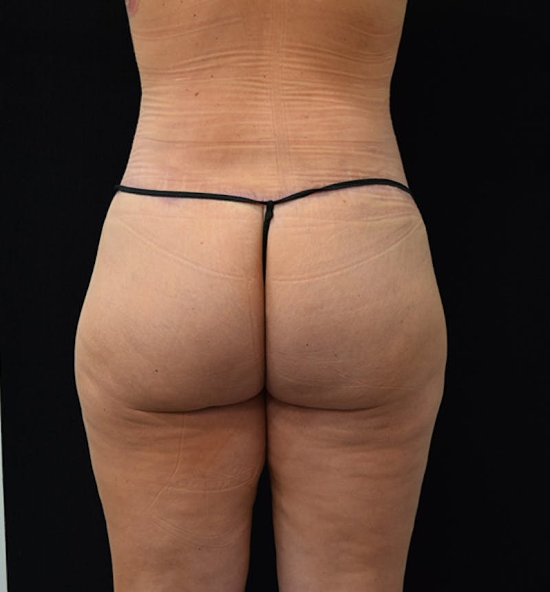 Lower Body Lift Before & After Gallery - Patient 102567025 - Image 12