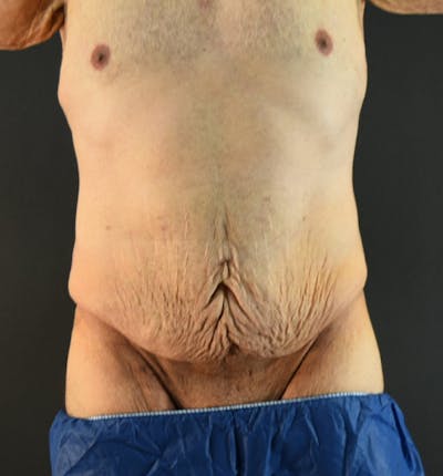 Lower Body Lift Before & After Gallery - Patient 148037530 - Image 1